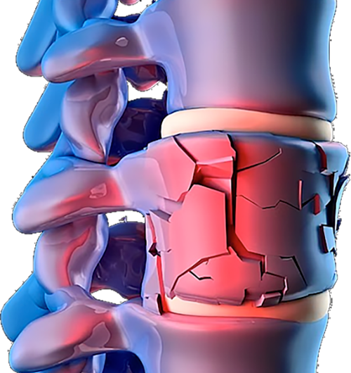 cura osteoporosi ortopedico milano post menopausa terapia